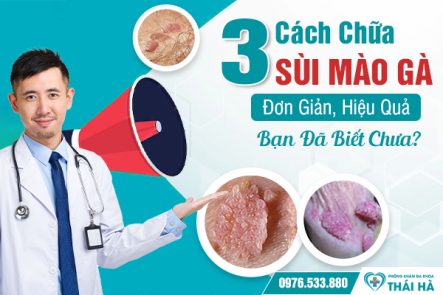 3 Cách Chữa Sùi Mào Gà Đơn Giản, Hiệu Quả Bạn Đã Biết Chưa?