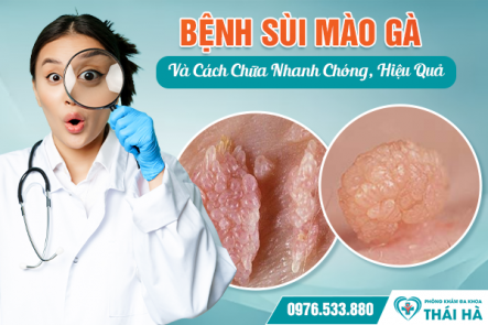 Bệnh Sùi Mào Gà Và Cách Chữa Nhanh Chóng, Hiệu Quả