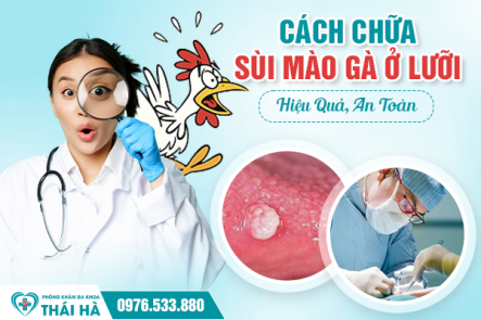 Cách Chữa Sùi Mào Gà Ở Lưỡi An Toàn, Không Đau