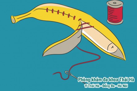 CẮT BAO QUY ĐẦU QUY TRÌNH NHƯ THẾ NÀO?