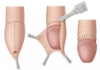 TẠI SAO PHẢI CẮT BAO QUY ĐẦU?