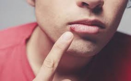 CHỮA BỆNH LẬU HIỆU QUẢ Ở ĐÂU HÀ NỘI?