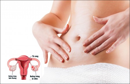 CHỮA VIÊM BUỒNG TRỨNG BẰNG CÁCH NÀO HIỆU QUẢ